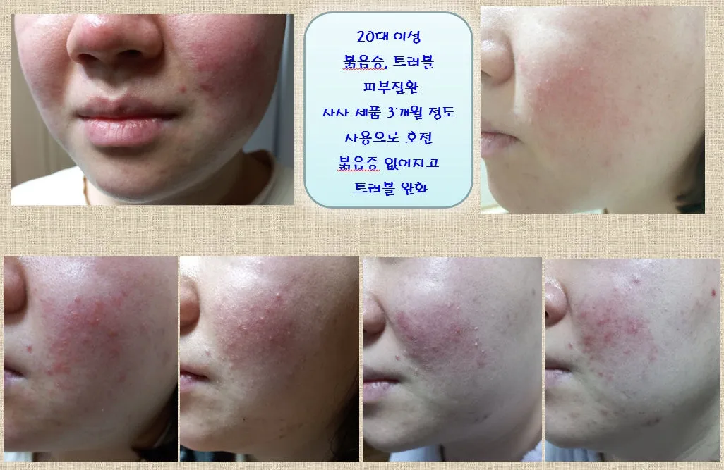 Basic Concept Creams Trouble Acne Atopy Sensitive Skincare Facial Moisture